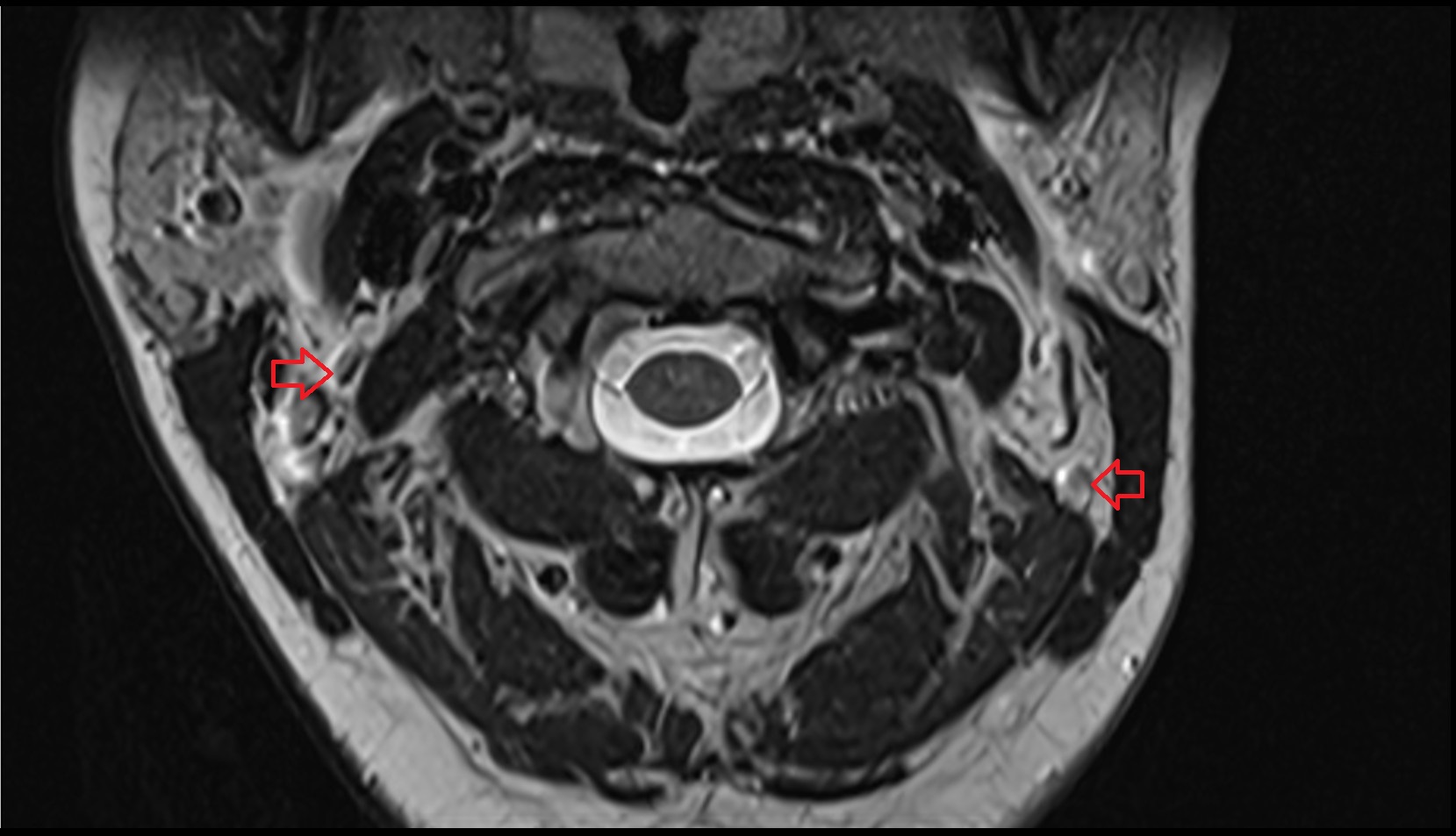 Superior deep cervical lymph nodes