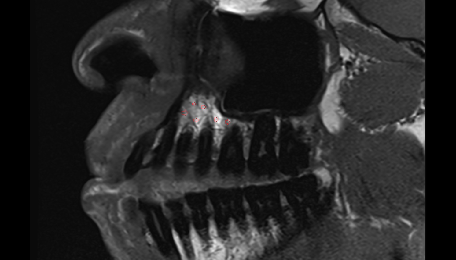 Superior dental plexus mri axial  image -img-00000-00000