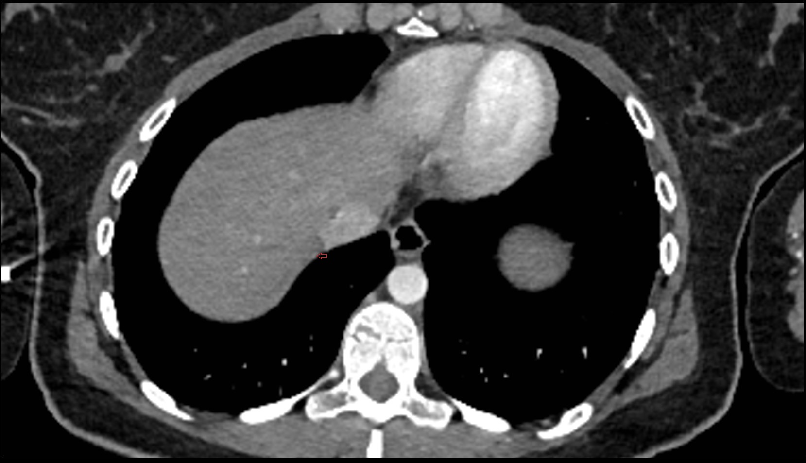 Superior diaphragmatic lymph nodes