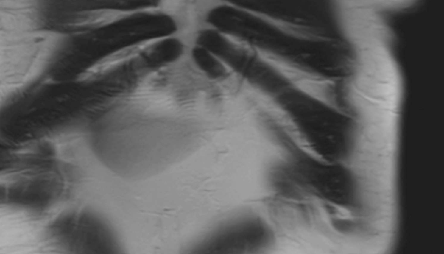 Superior epigastric artery coronal  anatomy  image -img-00000-00000_00001