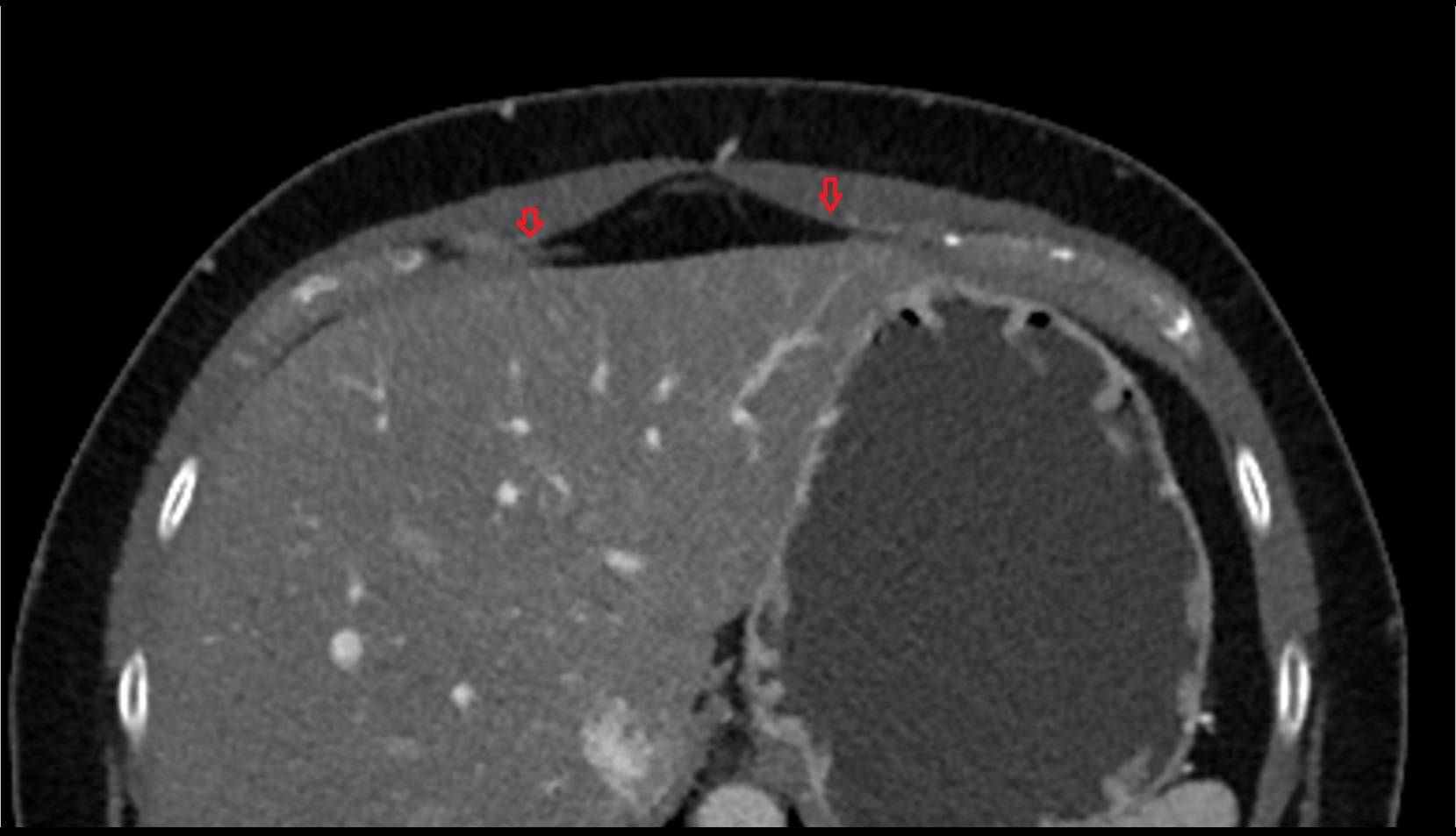 Superior epigastric veins CT AXIAL