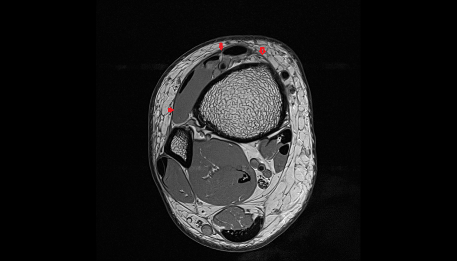 Superior extensor retinaculum axial  cross sectional anatomy 3T MRI AI enhanced radiology image-img-00000-00000