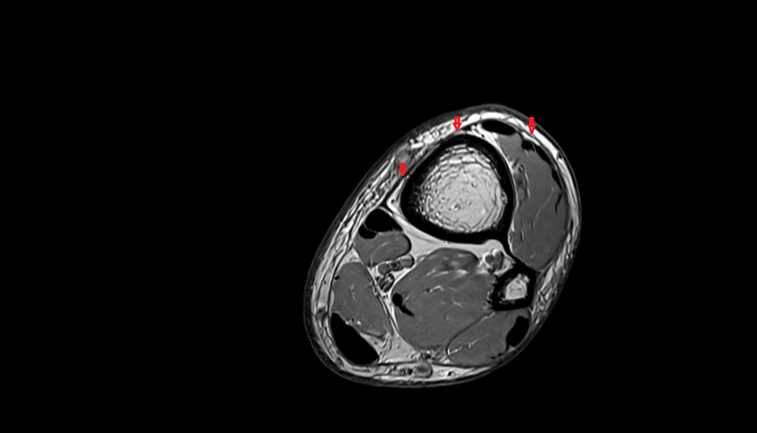 Superior extensor retinaculum axial  cross sectional anatomy 3T MRI AI enhanced radiology image-img-00000-00000_00001