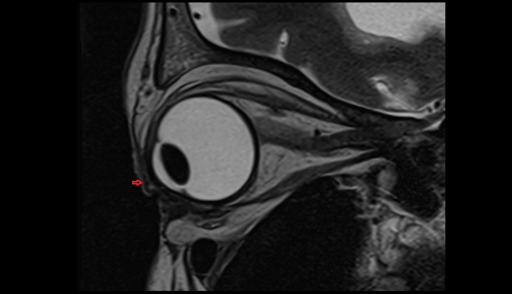 Superior eyelid mri image