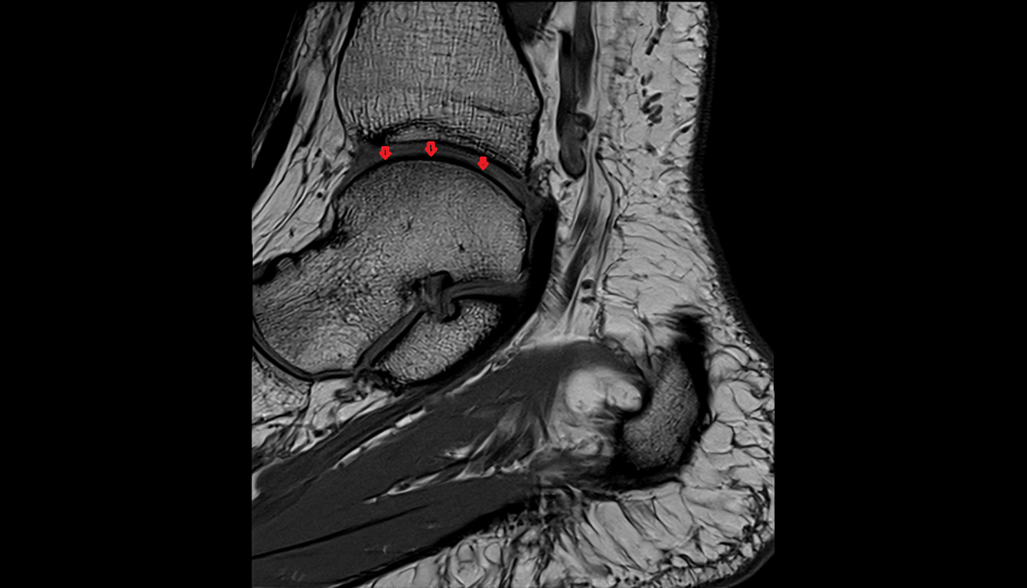 Superior facet of talus  mri  anatomy labelled image-img-00000-00000