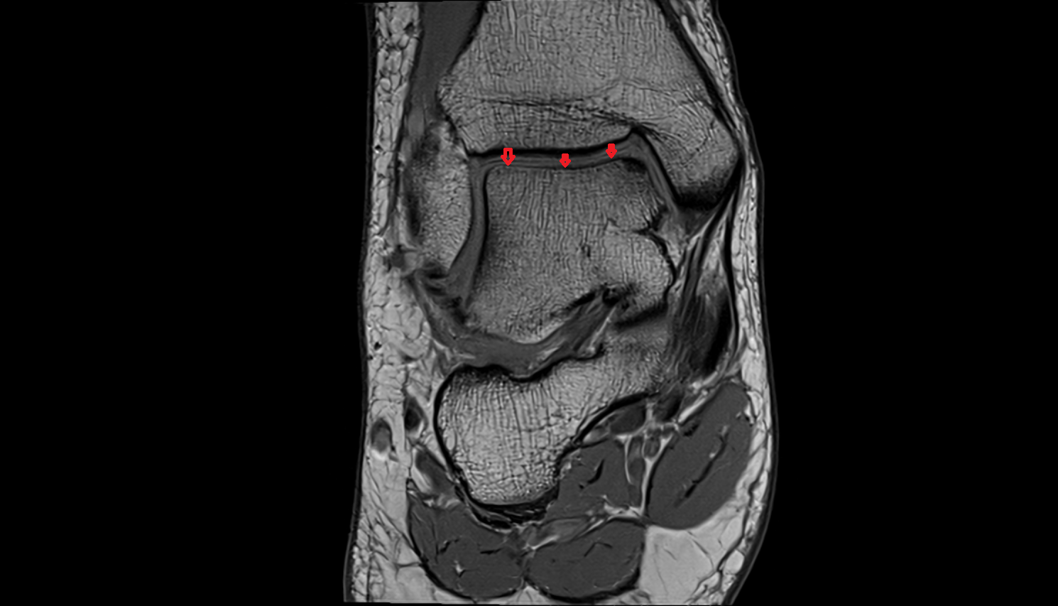 Superior facet of talus  mri  anatomy labelled image-img-00000-00000_00001
