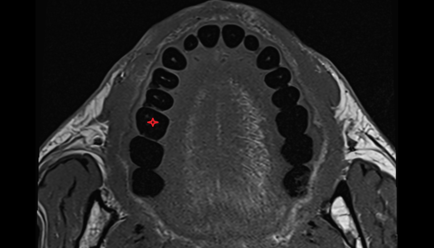 Superior first molar tooth  mri axial  image -img-00000-00000