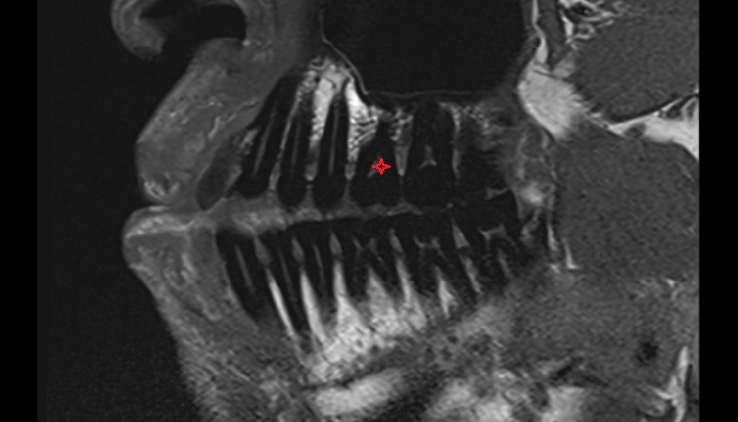 Superior first molar tooth mri sag  image -img-00000-00000
