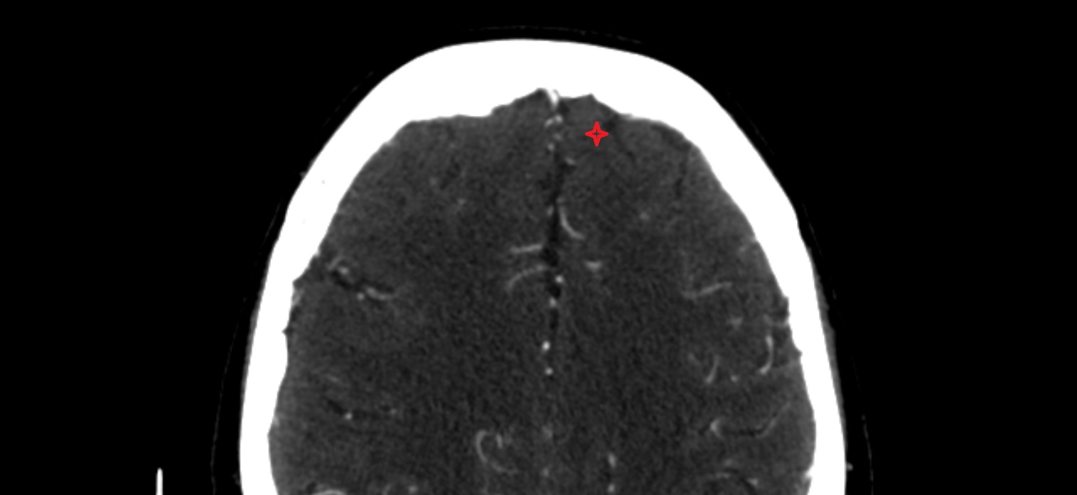 Superior frontal gyrus  CT axial  cross sectional anatomy radiology image
