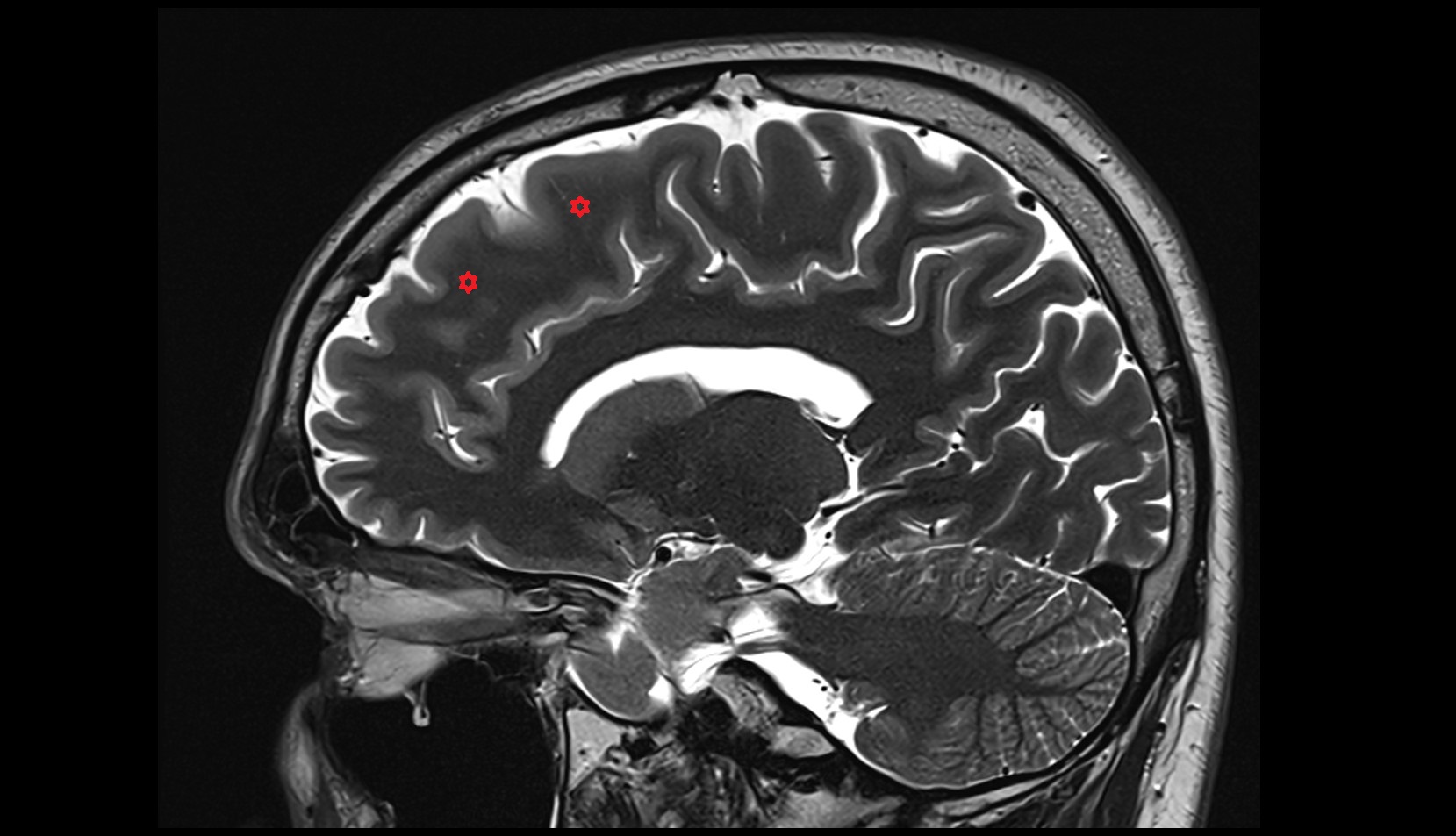 Superior frontal gyrus MRI 3T SAGITTAL IMAGE