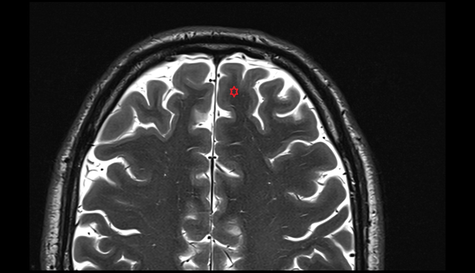 Superior frontal gyrus MRI 3T axial IMAGE