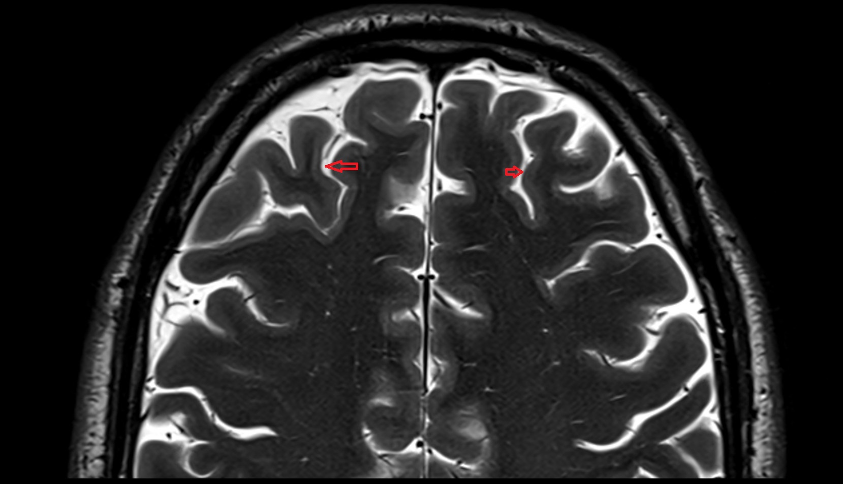 Superior frontal sulcus MRI 3T axial image