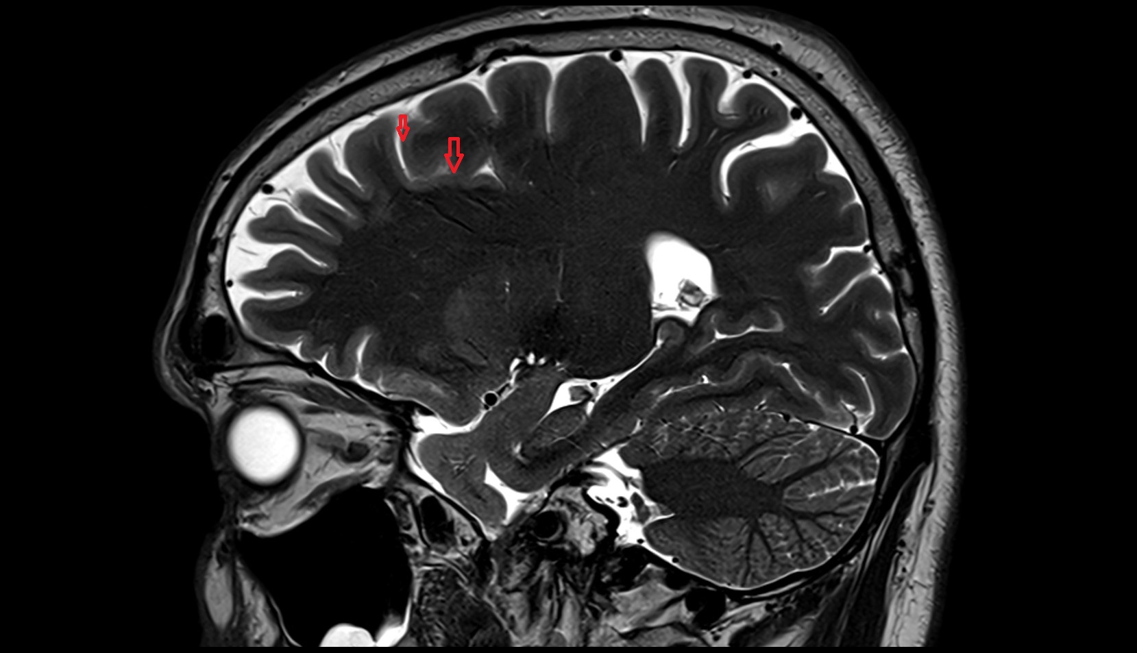 Superior frontal sulcus MRI 3T sagittal image