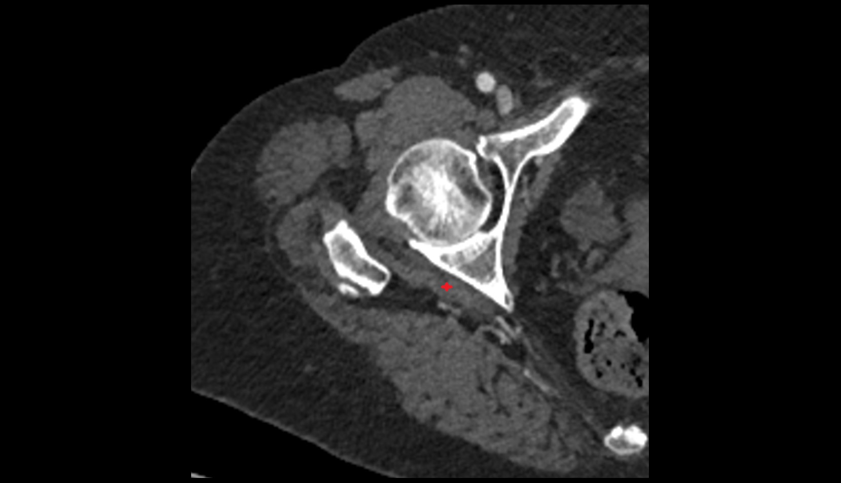 Superior gemellus muscle CT AXIAL IMAGE