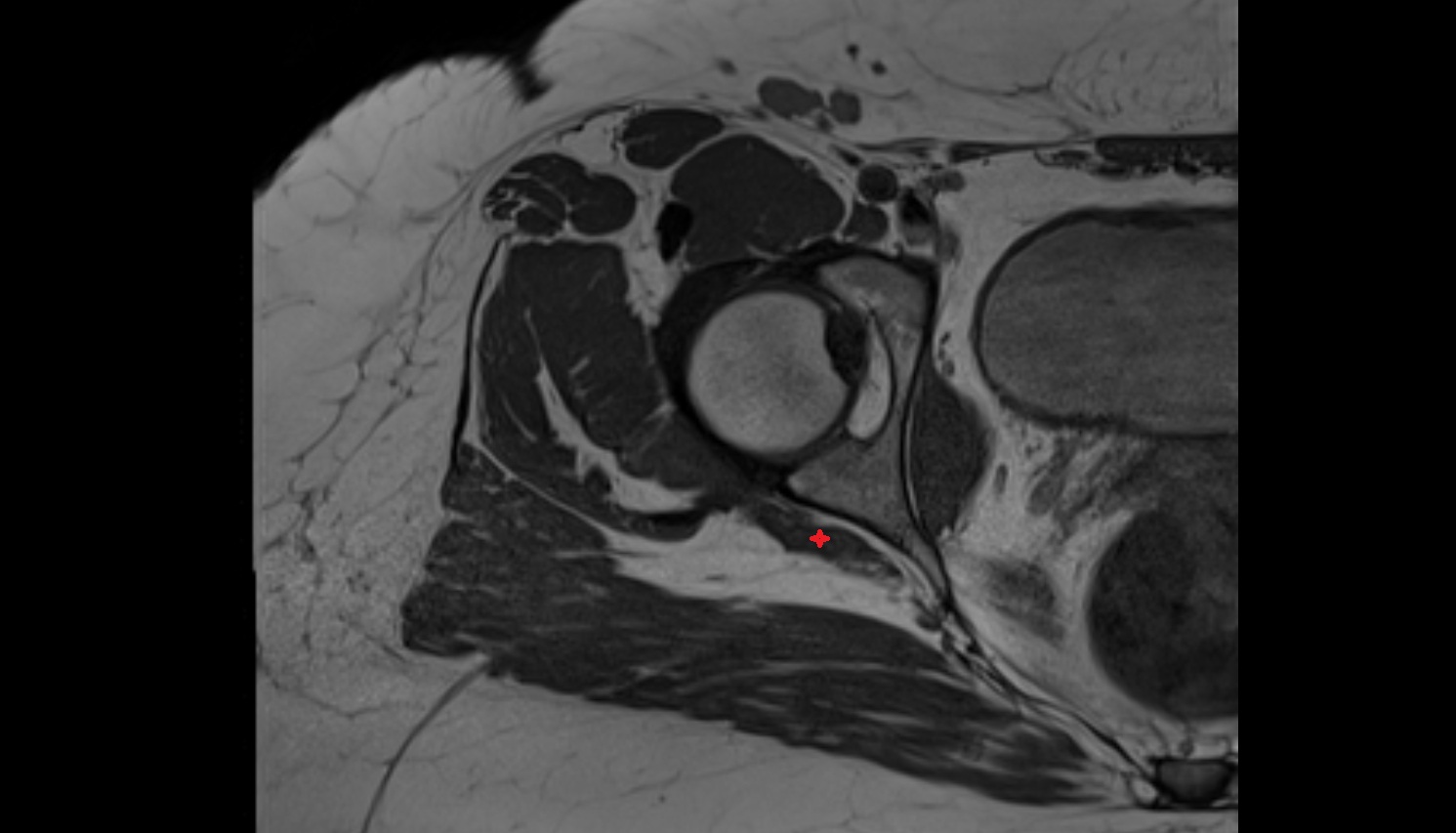Superior gemellus muscle   MRI  axial  anatomy  image-img-00000-00000
