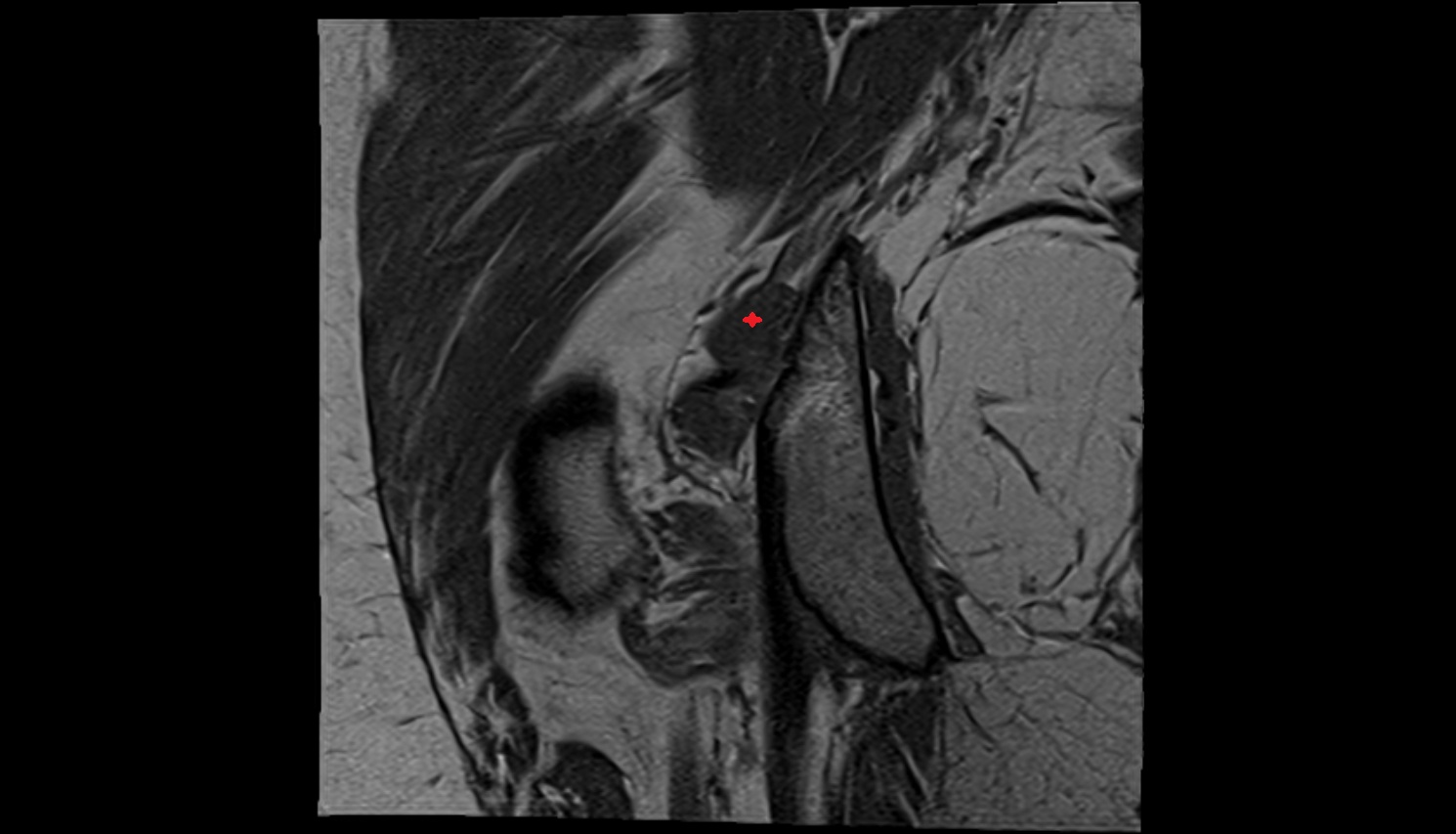 Superior gemellus muscle MRI coronal  anatomy image