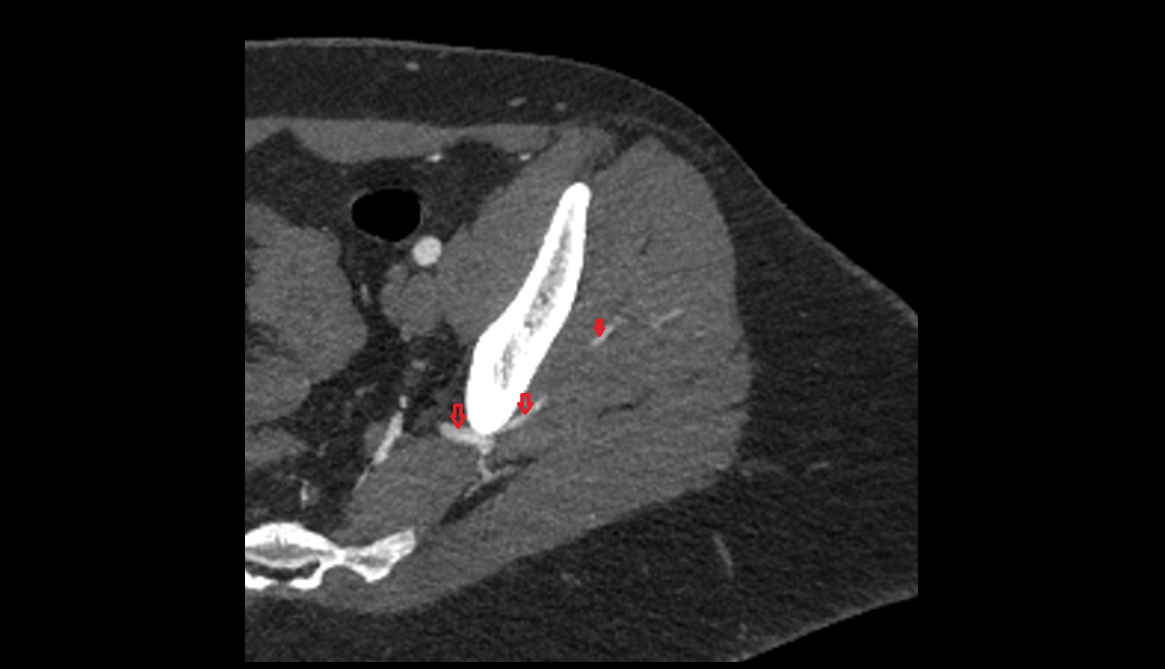 Superior gluteal artery ct axial