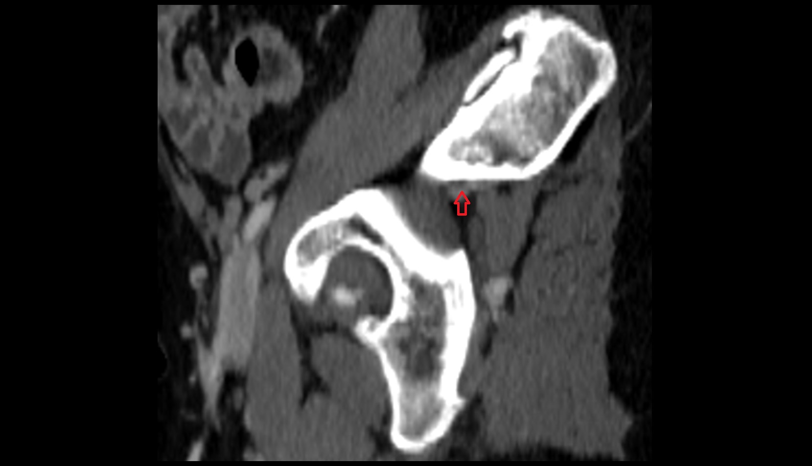 Superior gluteal vein ct sag image