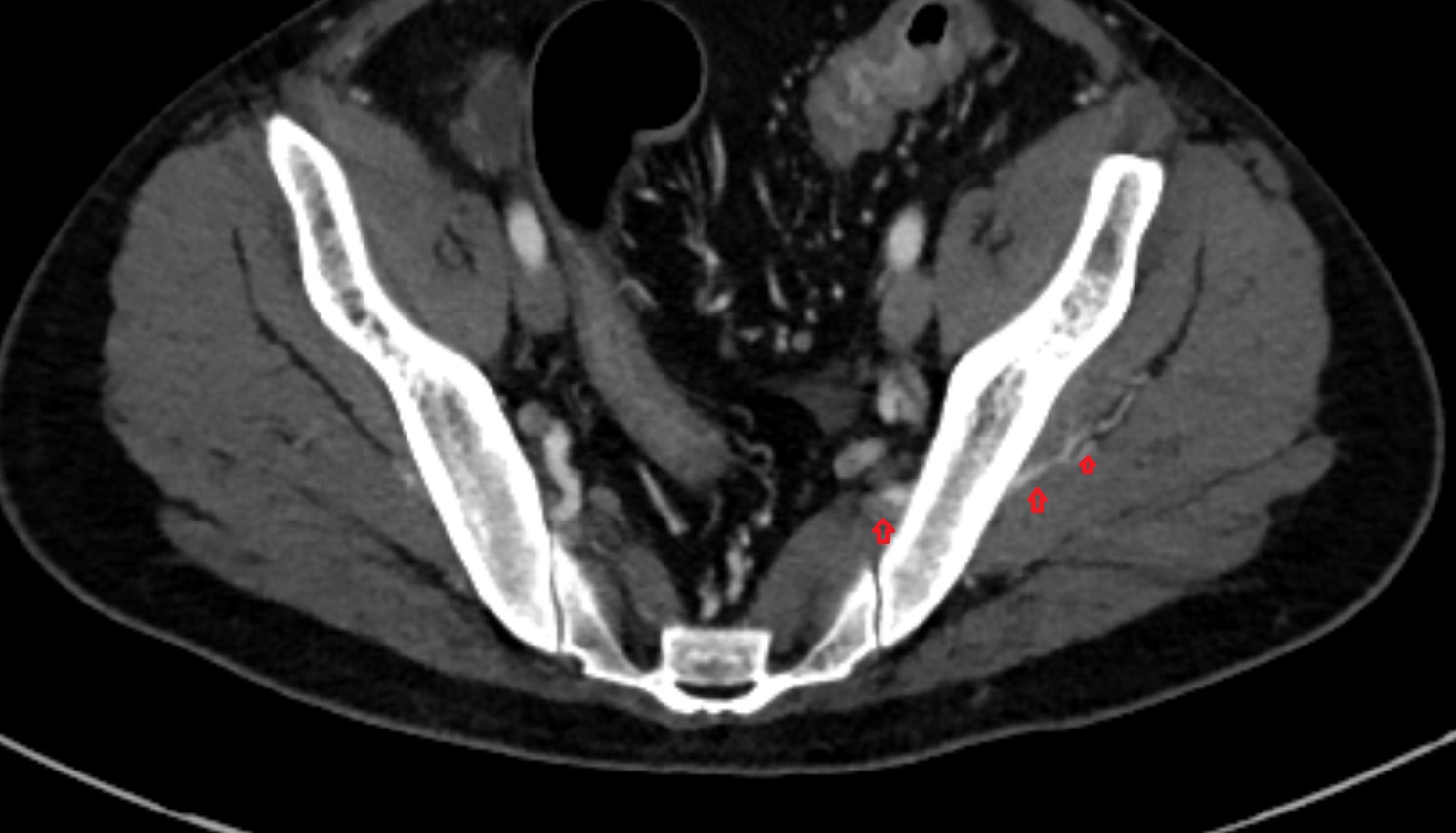 Superior gluteal veins  ct axial  anatomy  image-img-00000-00000