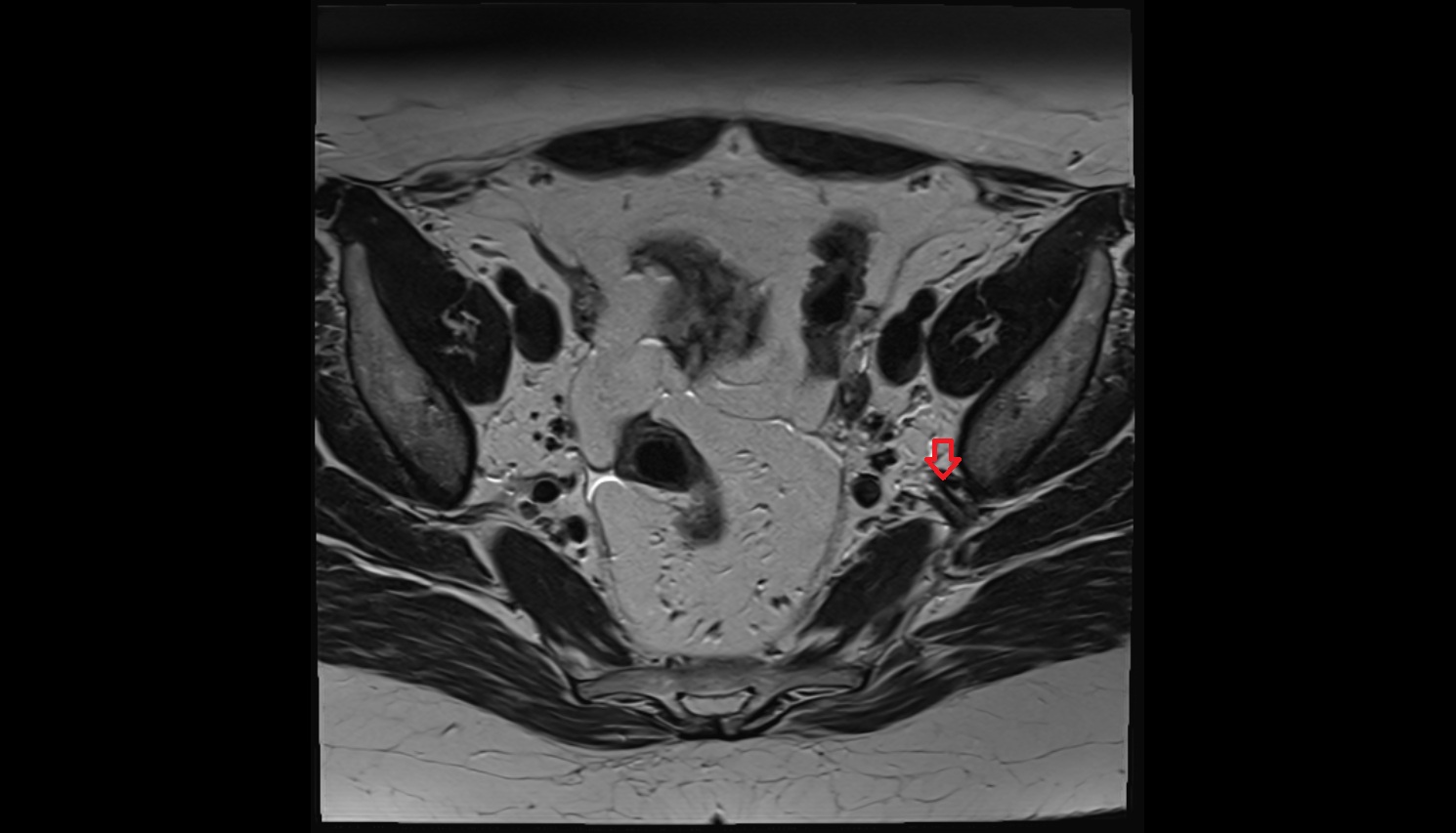 Superior gluteal veins  mri axial  anatomy  image-img-00000-00000