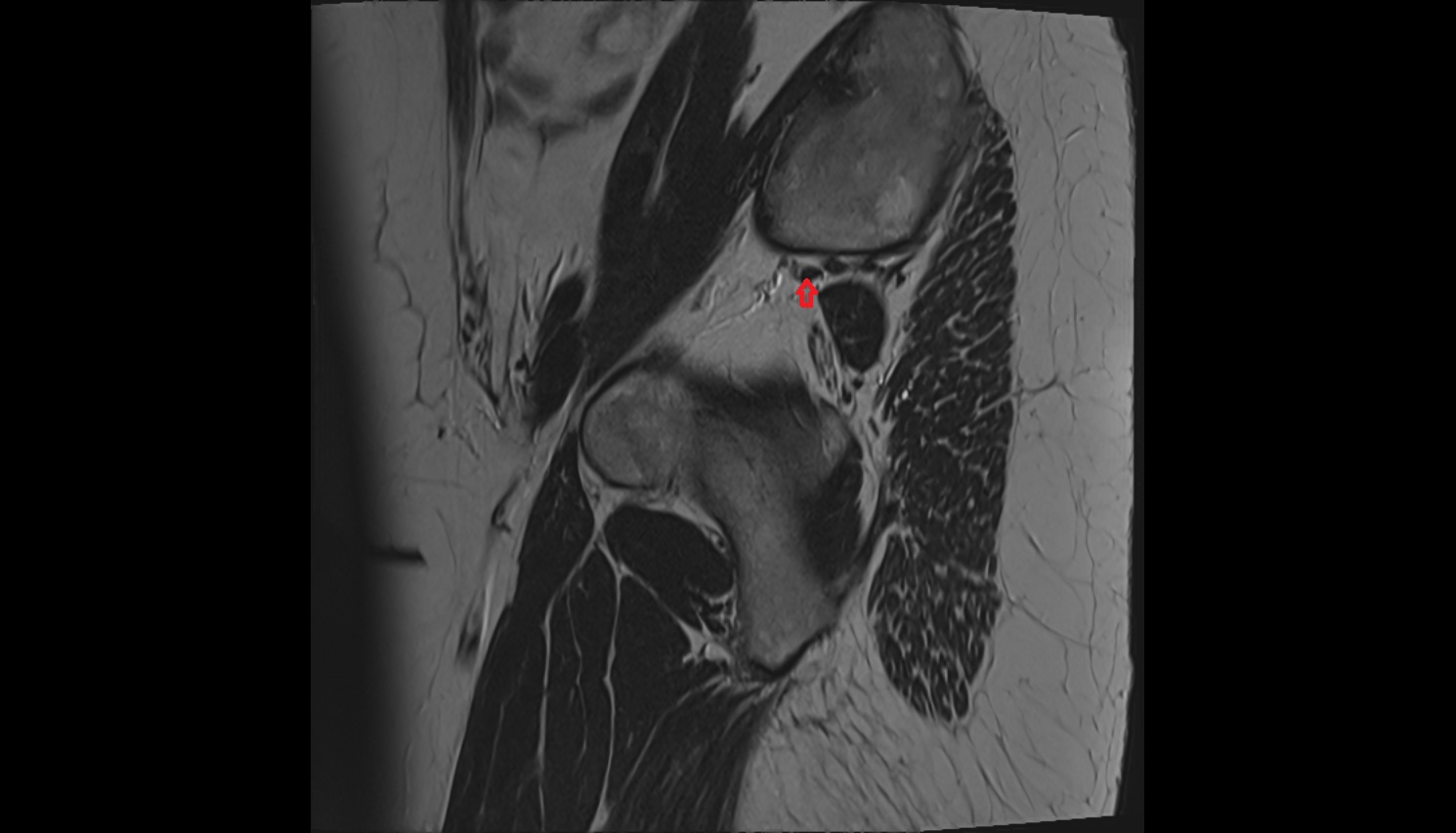 Superior gluteal veins  mri sag  anatomy  image-img-00000-00000