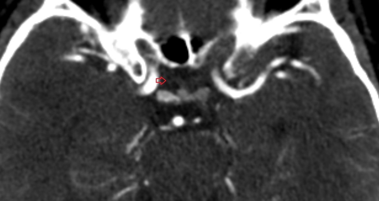Superior hypophyseal artery  CT coronal  anatomy image -img-00001-00001