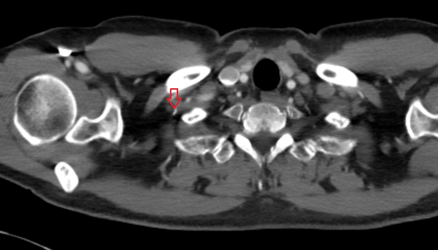 Superior intercostal artery  anatomy CT axial  image -img-00000-00000