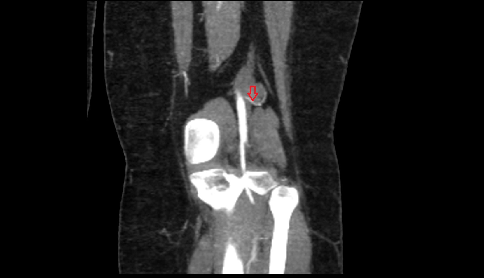 Superior lateral genicular artery CT CORONAL