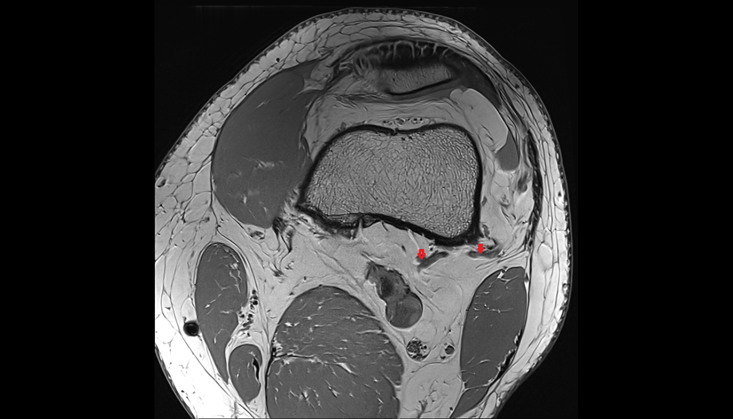 Superior lateral genicular vein axial cross sectional anatomy 3T MRI AI enhanced  radiology  anatomy image-img-00000-00000