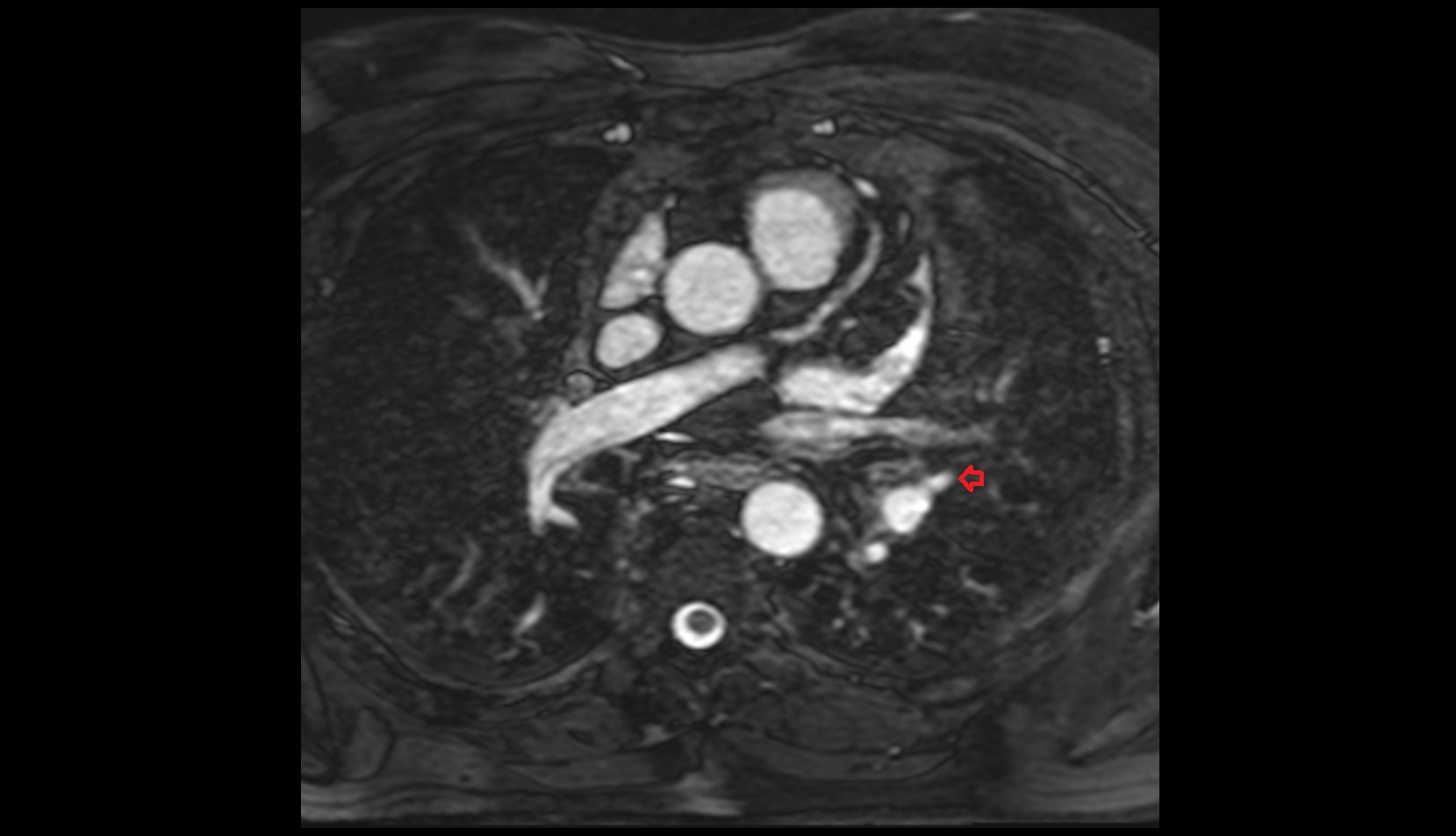 Superior lingular artery of left lung MRI AXIAL IMAGE