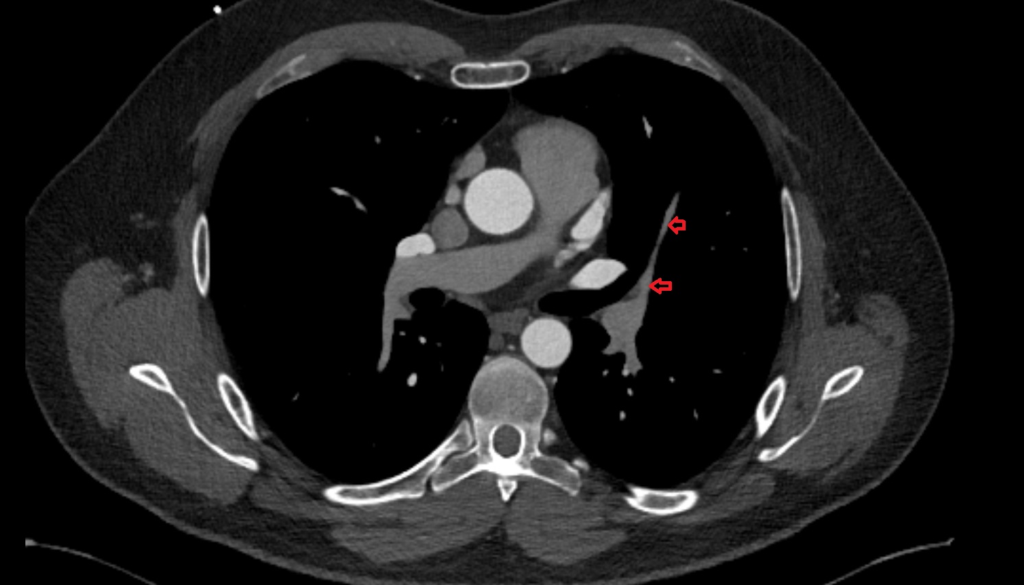 Superior lingular artery of left lung   anatomy CT axial  image -img-00000-00000