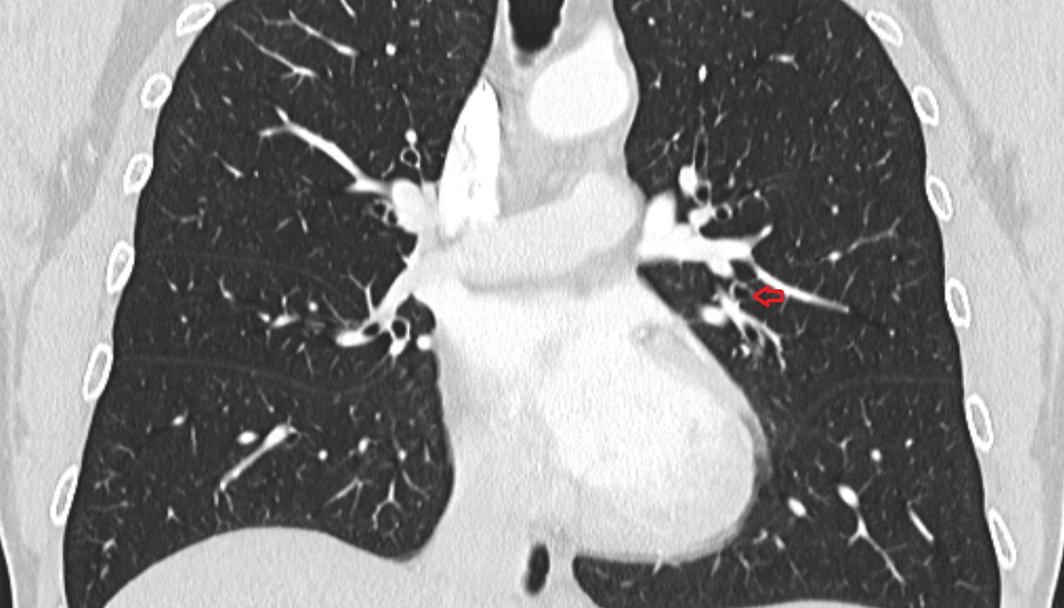 Superior lingular bronchus of left lung (B4)  anatomy  CT coronal  image -img-00000-00000