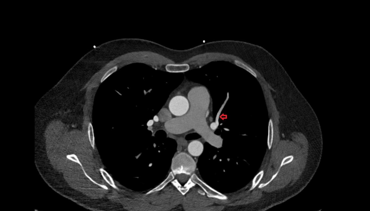 Superior lingular vein of left lung CT axial image -img-00000-00000