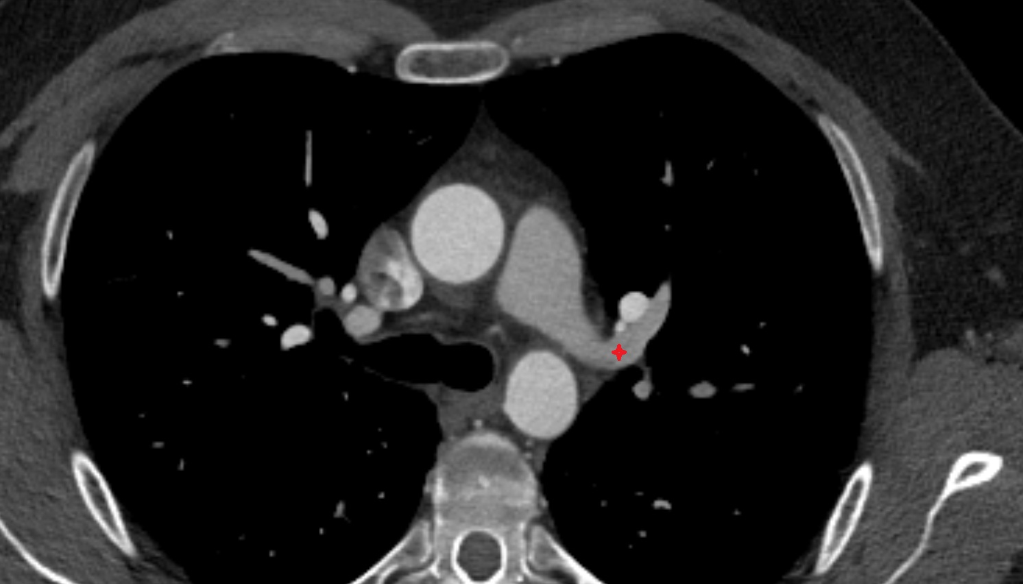 Superior lobar artery of left lung anatomy CT axial  image -img-00000-00000