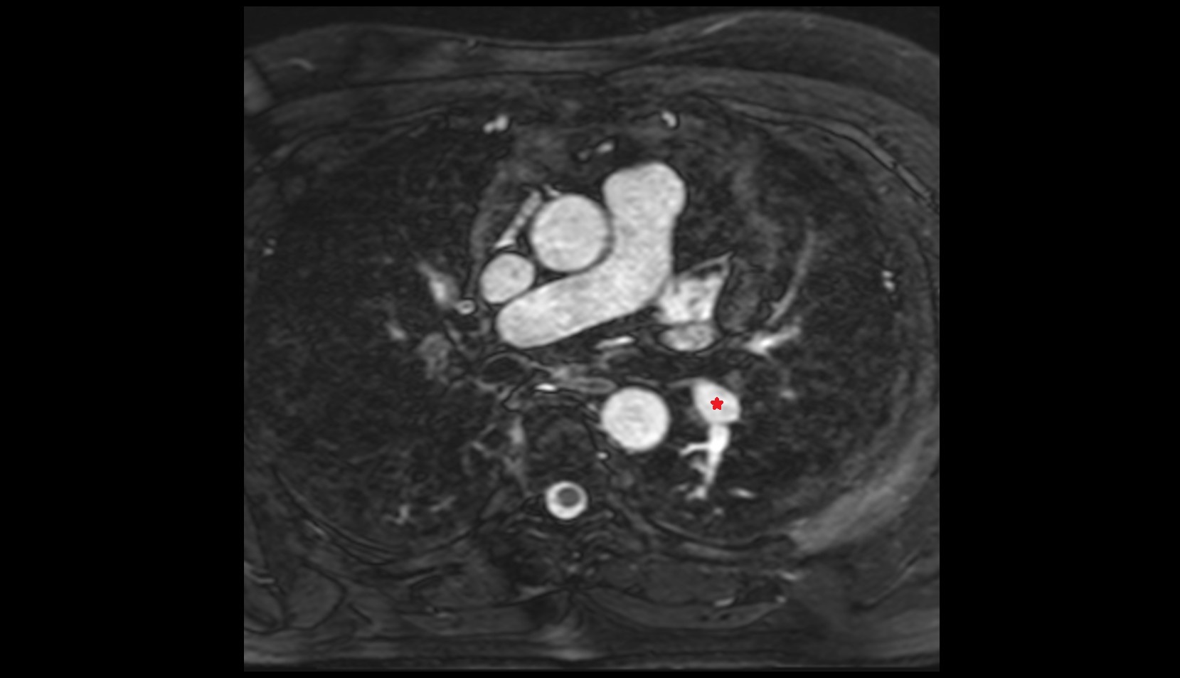 Superior lobar artery of left lung mri image