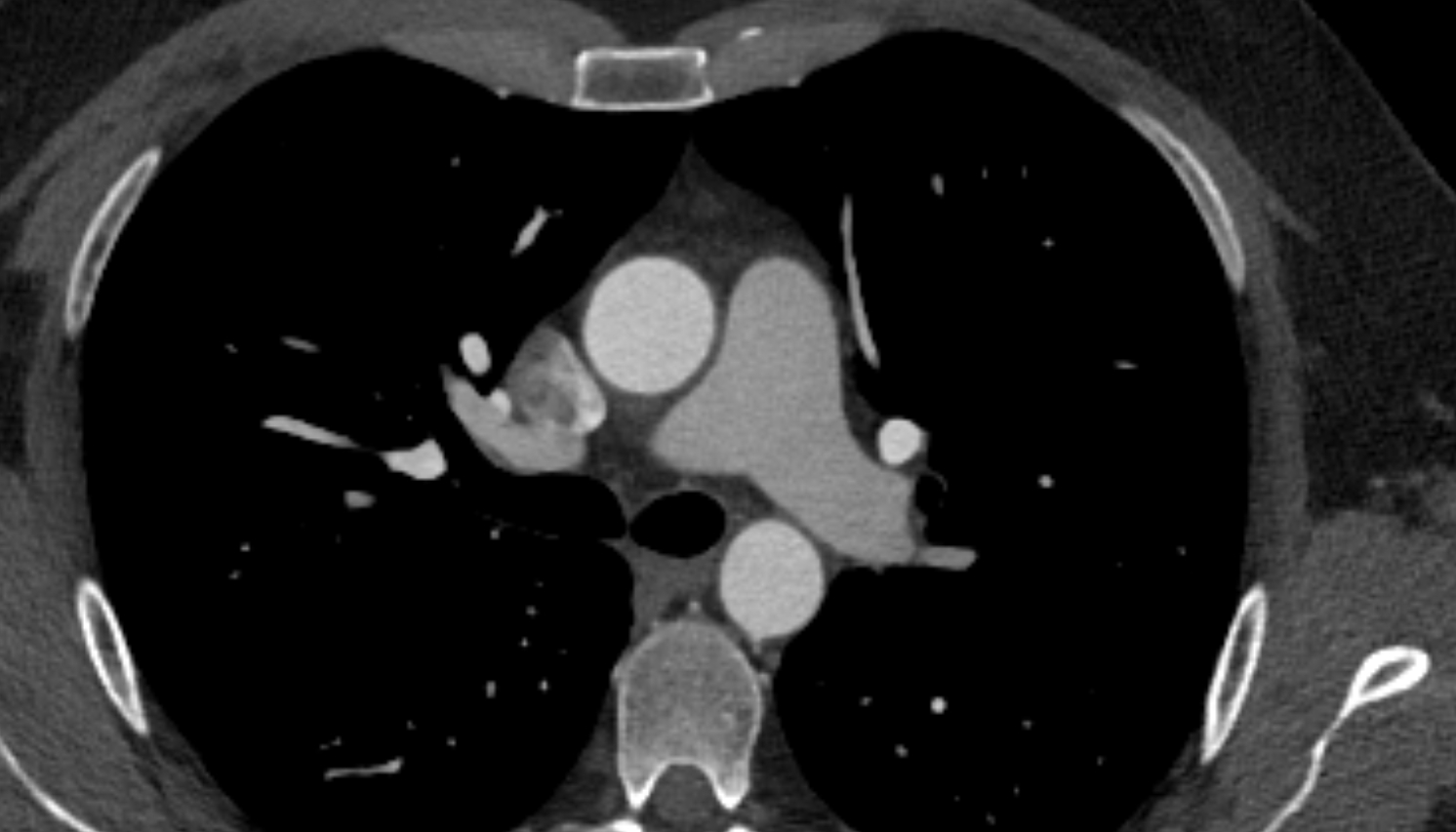 Superior lobar artery of right lung  anatomy CT axial  image -img-00000-00000