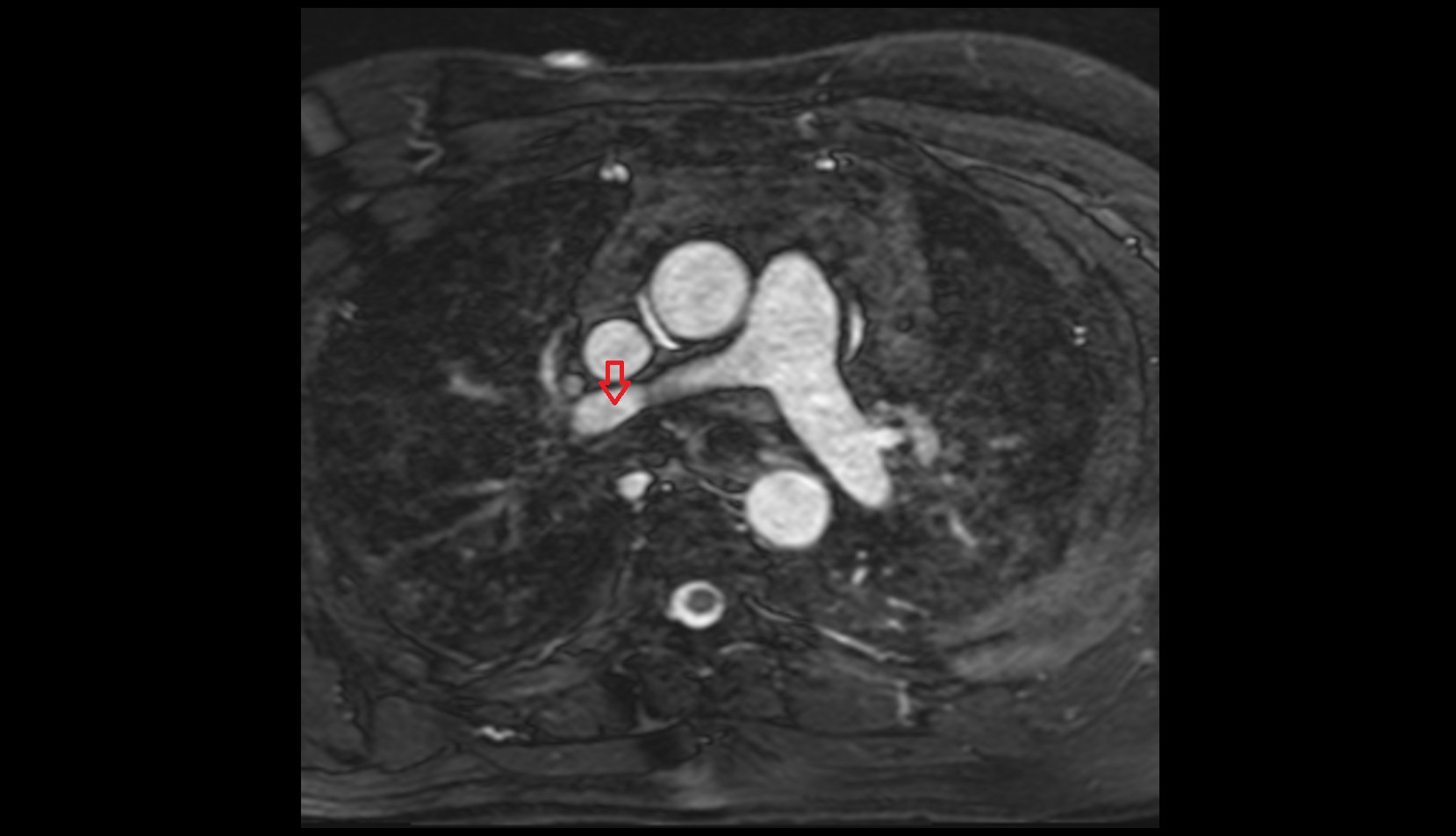 Superior lobar artery of right lung  anatomy mri image