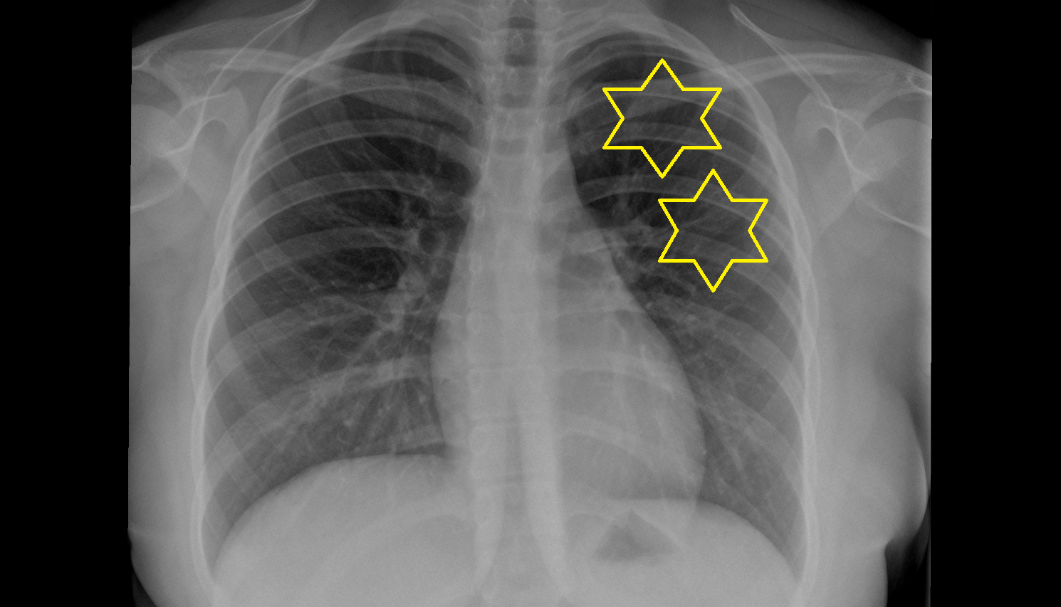 Superior lobe of left lung X RAY anatomy image -img-00000-00000
