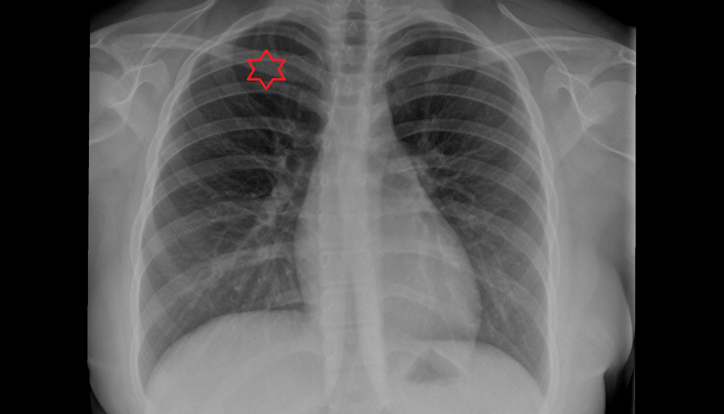 Superior lobe of right lung X RAY anatomy image -img-00000-00000