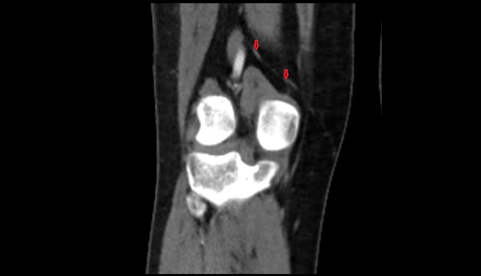 Superior medial genicular artery CT CORONAL