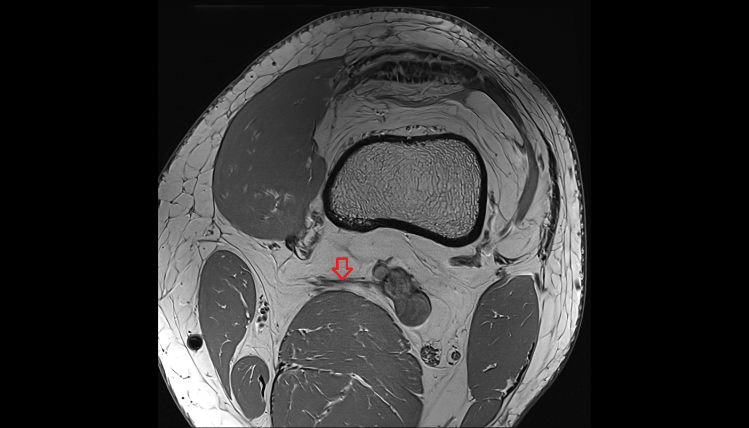 Superior medial genicular artery MRI  AXIAL  cross sectional anatomy 3T MRI AI enhanced  radiology  anatomy image-img-00000-00000