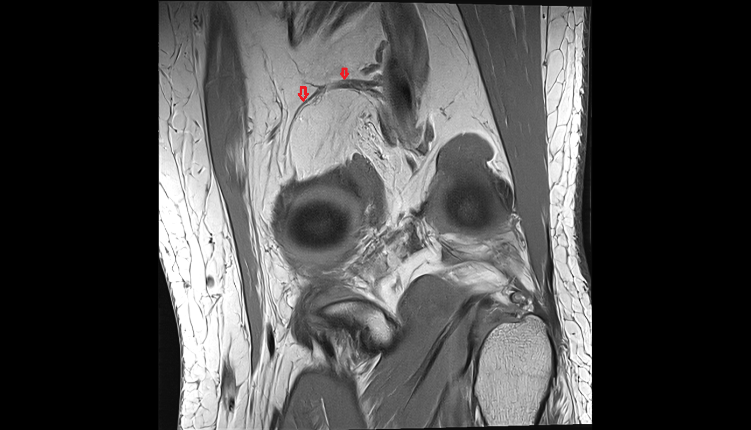 Superior medial genicular artery MRI  CORONAL  cross sectional anatomy 3T MRI AI enhanced  radiology  anatomy image-img-00000-00000