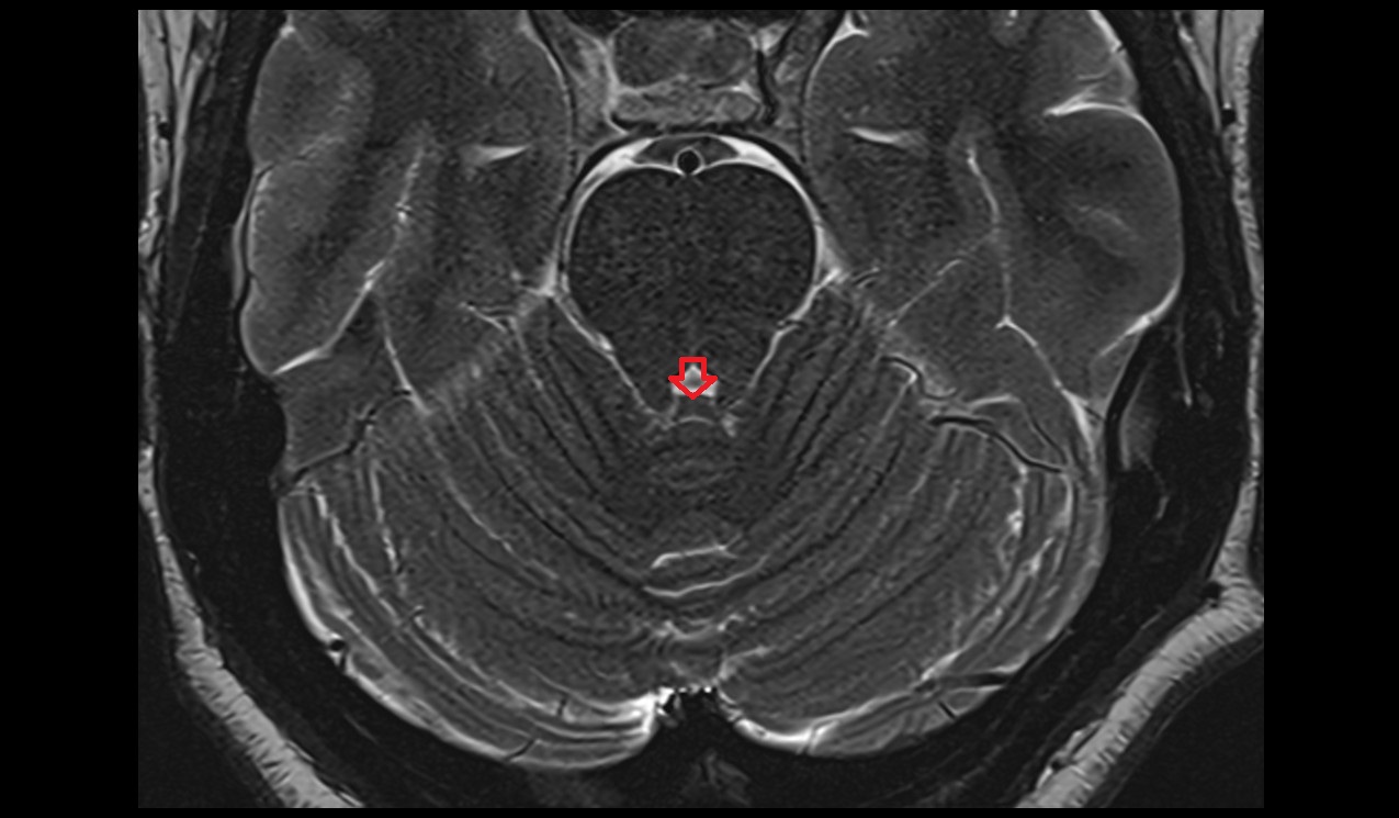 Superior medullary velum MRI 3T axial image