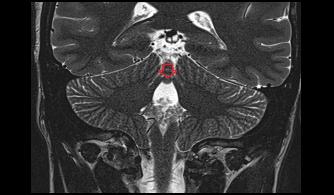 Superior medullary velum MRI 3T coronal image