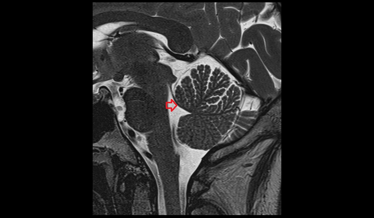 Superior medullary velum mri 3T sagittal image