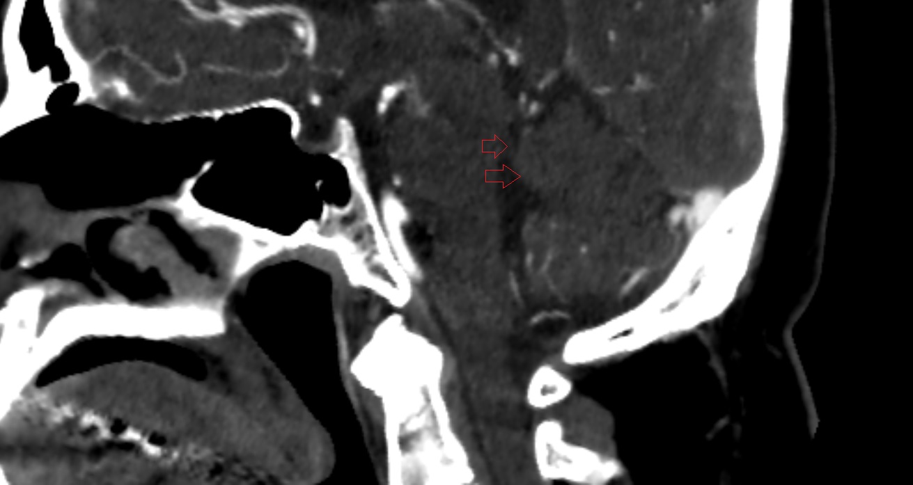 Superior medullary velum of cerebellum  CT sag  anatomy image -img-00001-00001