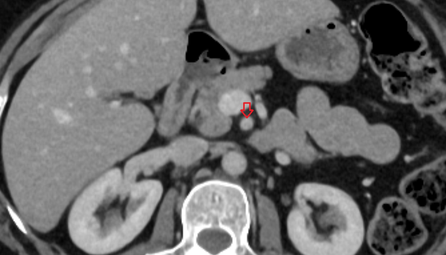 Superior mesenteric artery (SMA) AXIAL CT  anatomy  image -img-00000-00000