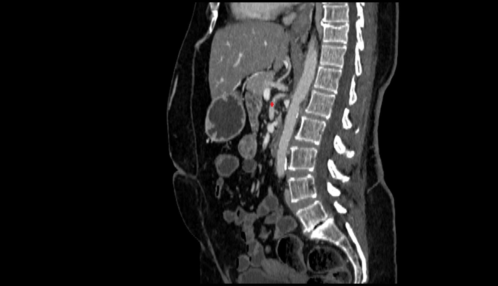 Superior mesenteric artery (SMA) CT SAG IMAGE