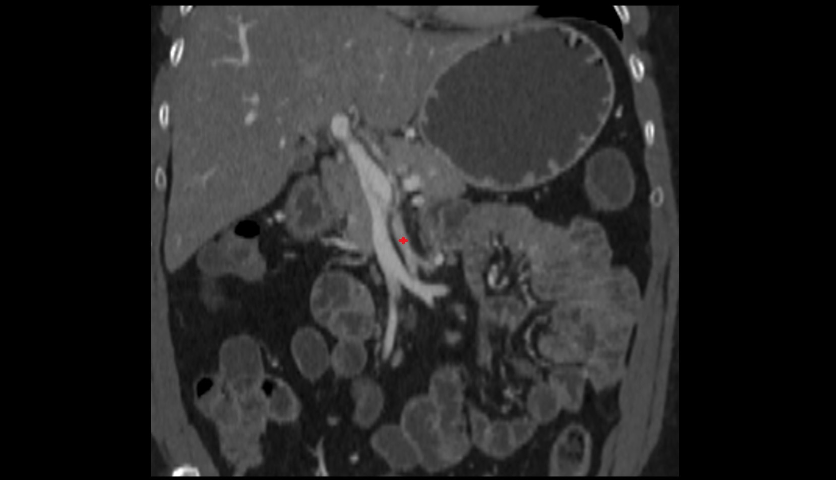 Superior mesenteric artery (SMA) coronal CT  anatomy  image