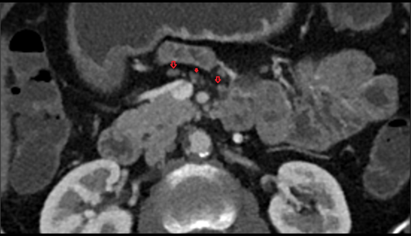 Superior mesenteric lymph nodes CT axial imag